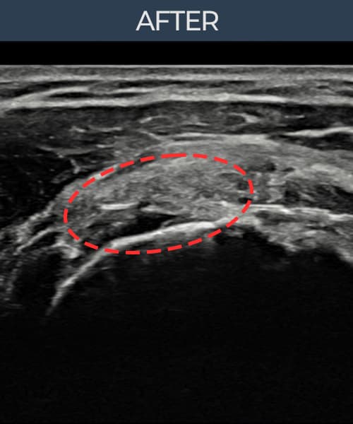 病例No.1 — 术后