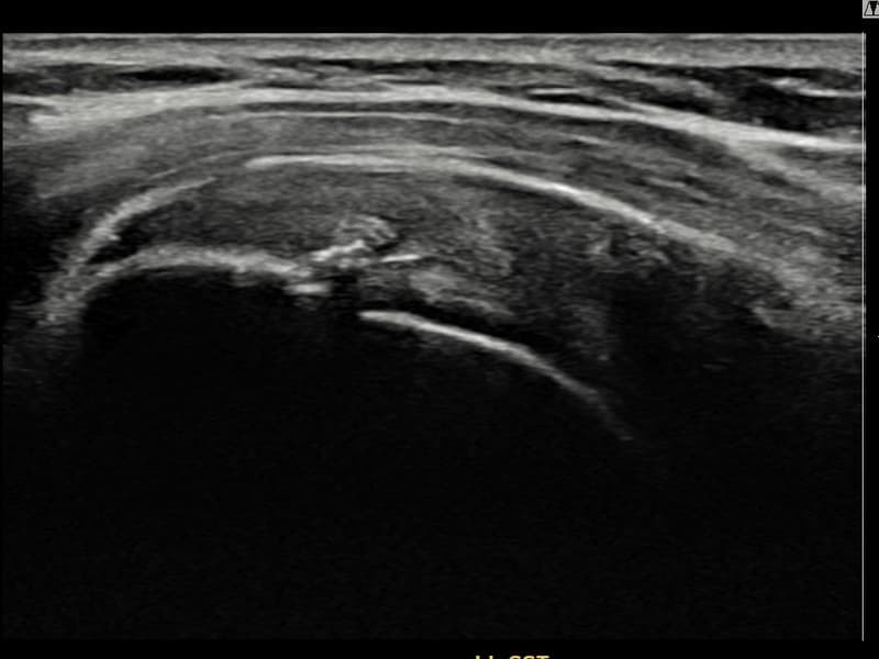 病例No.11 — 术后