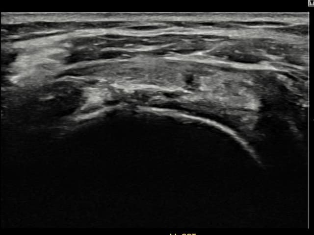 김ㅇㅇ님 시술 후