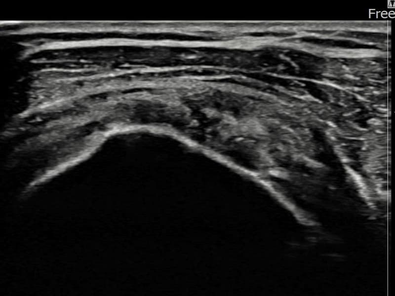 病例No.20 — 术后