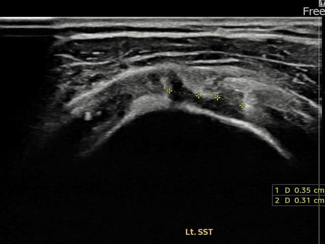서ㅇㅇ님 시술 전