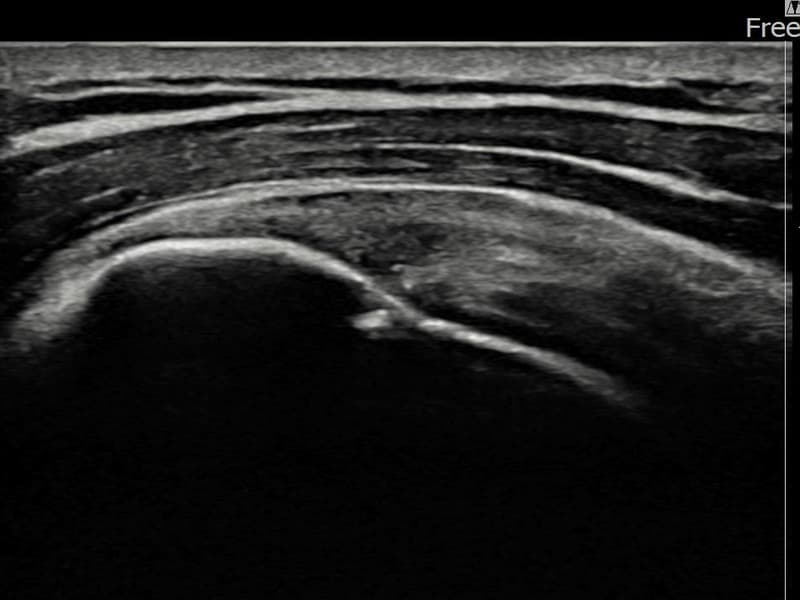 病例No.23 — 术后