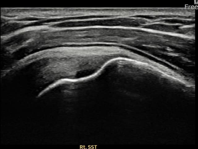 허ㅇㅇ님 시술 후