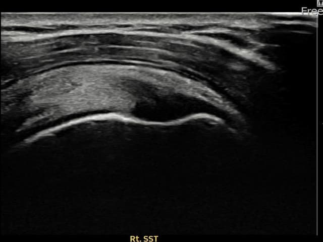 우측 극상근건 부착부 부분파열 어깨인대 축소봉합술 시술 전 초음파 — 허ㅇㅇ님 | 플래티넘의원