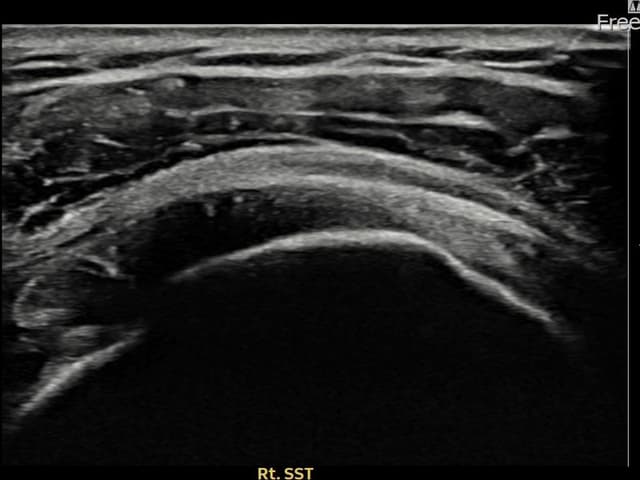 허ㅇㅇ님 시술 전