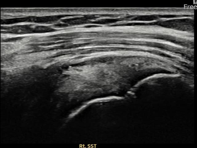 최ㅇㅇ님 시술 후