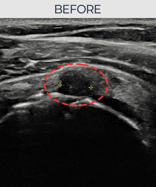 조ㅇㅇ님 시술 전