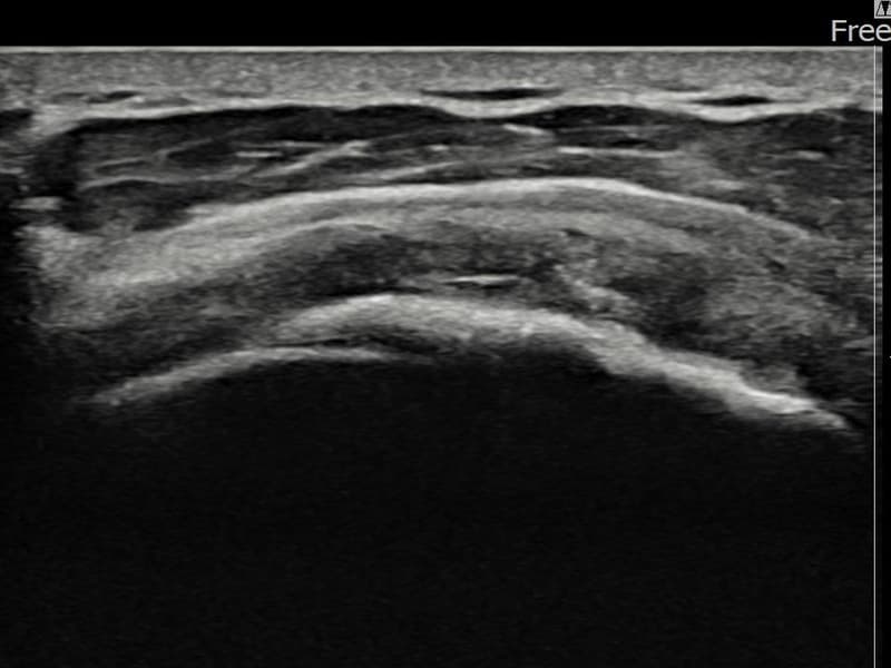 病例No.30 — 术后