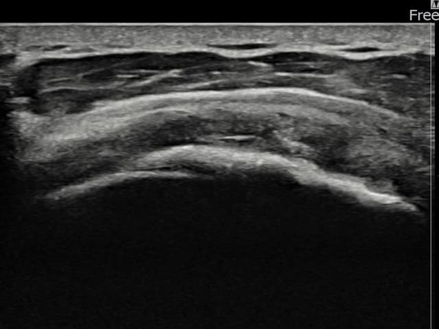 김ㅇㅇ님 시술 후