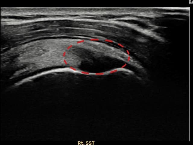 허ㅇㅇ님 시술 전