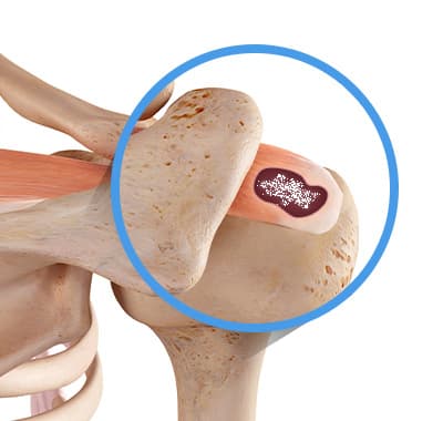 석회분쇄흡입술 케이스 1