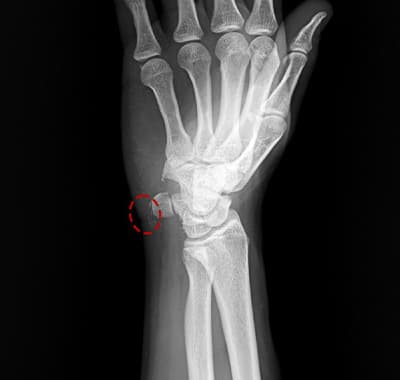 석회분쇄흡입술 케이스 2