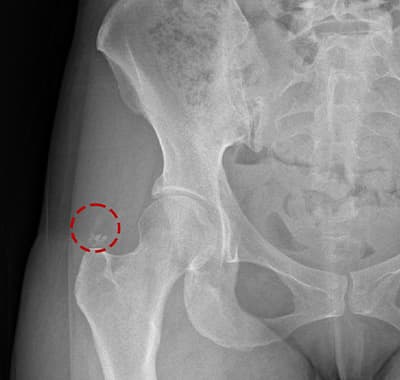 석회분쇄흡입술 케이스 3