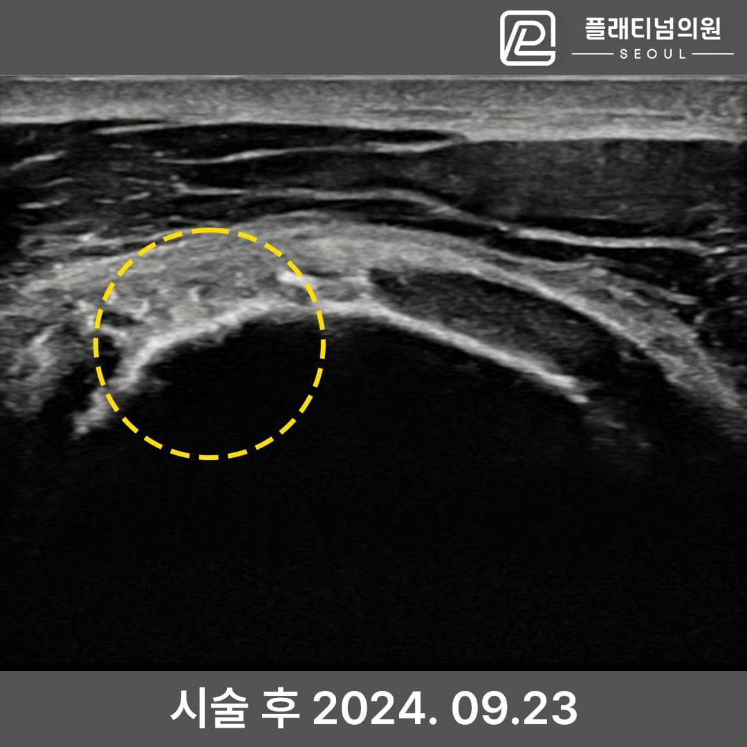 인대재생주사 성공사례 2