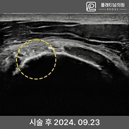인대 축소봉합술 시술 후