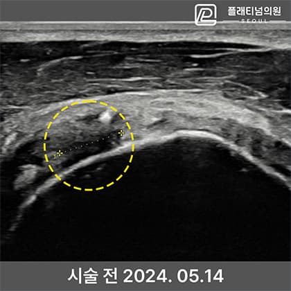 인대 축소봉합술 시술 전