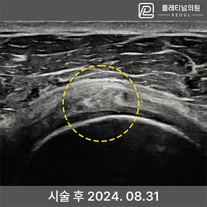 골수자극 줄기세포 치료 후