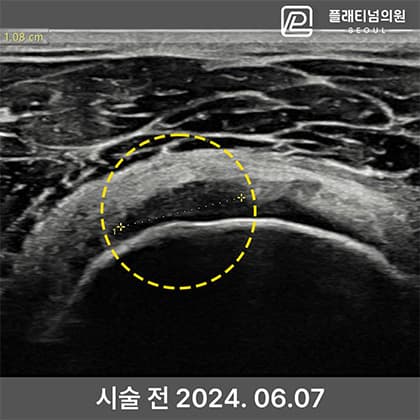 골수자극 줄기세포 치료 전