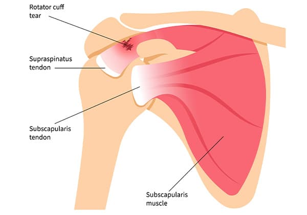 파열된 회전근개