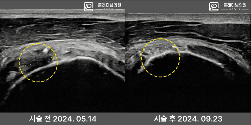 Ligament regeneration injection before and after ultrasound comparison