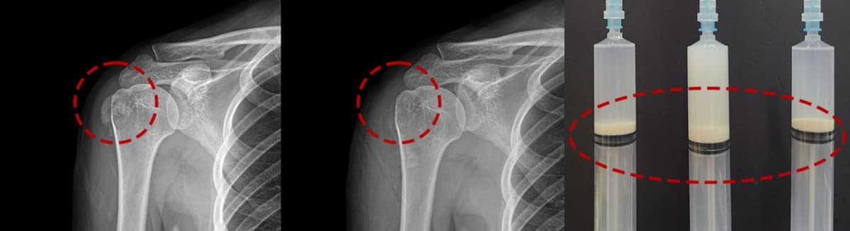 Calcific tendinitis before procedure — calcium deposit visible on X-ray