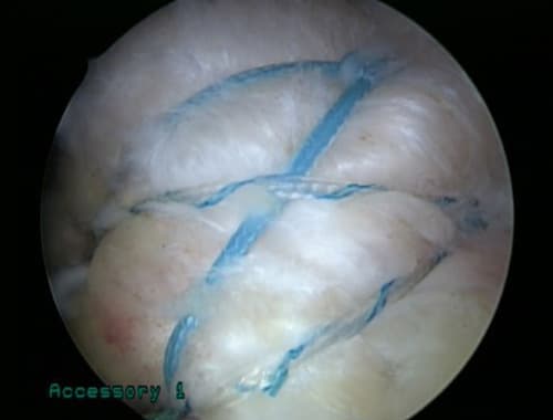 Rotator cuff plication suture — suture procedure view