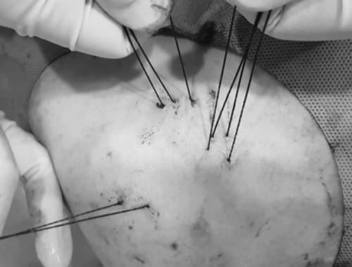 Rotator cuff repair complete — tendon anchored to bone