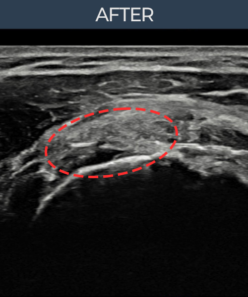 회전근개 관절면측 부분파열 비수술 치료 후 초음파 — 플래티넘의원