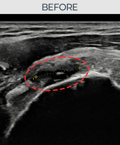 회전근개 관절면측 부분파열 비수술 치료 전 초음파 — 플래티넘의원