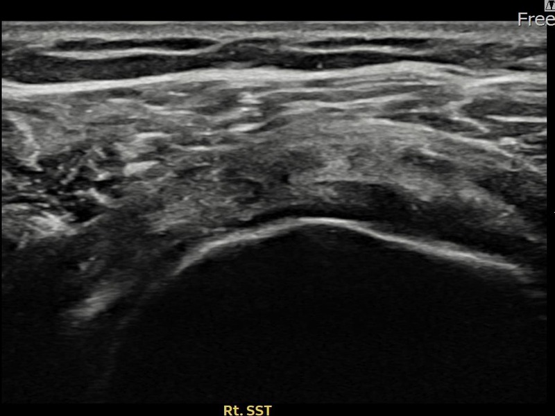 우측 극상근건 관절면측 파열 진행형 비수술 치료 후 초음파 — 플래티넘의원