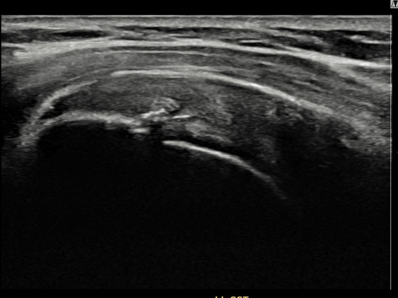 좌측 극상근건 관절면측 부분파열 비수술 치료 후 초음파 — 플래티넘의원