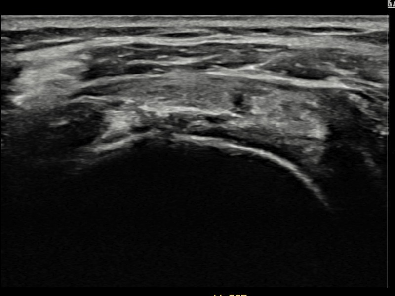 좌측 극상근건 점액낭면측 부분파열 비수술 치료 후 초음파 — 플래티넘의원
