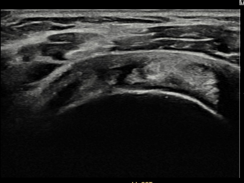 좌측 극상근건 점액낭면측 부분파열 비수술 치료 전 초음파 — 플래티넘의원
