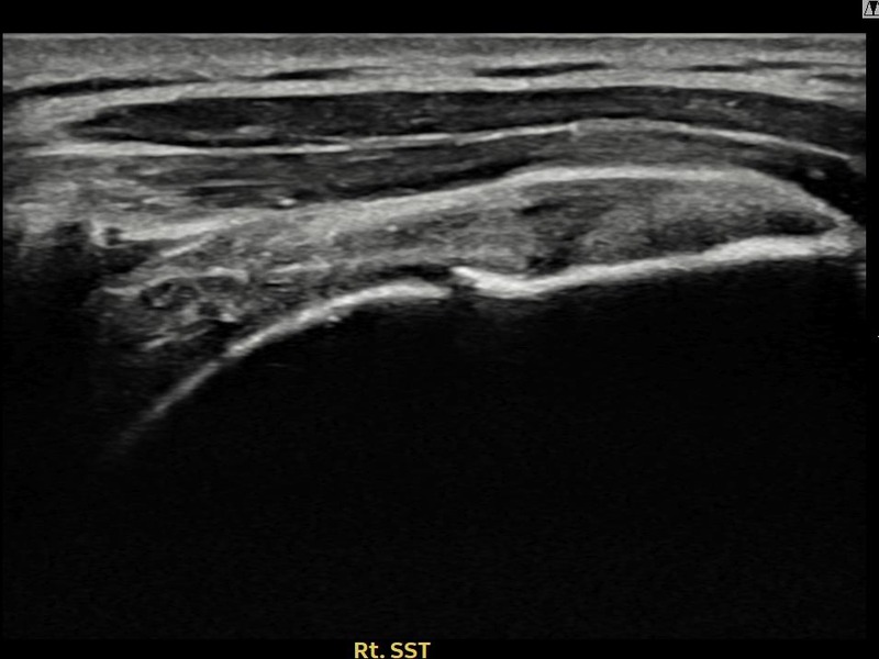 우측 극상근건 부분파열 + 건내 석회화 비수술 치료 후 초음파 — 플래티넘의원