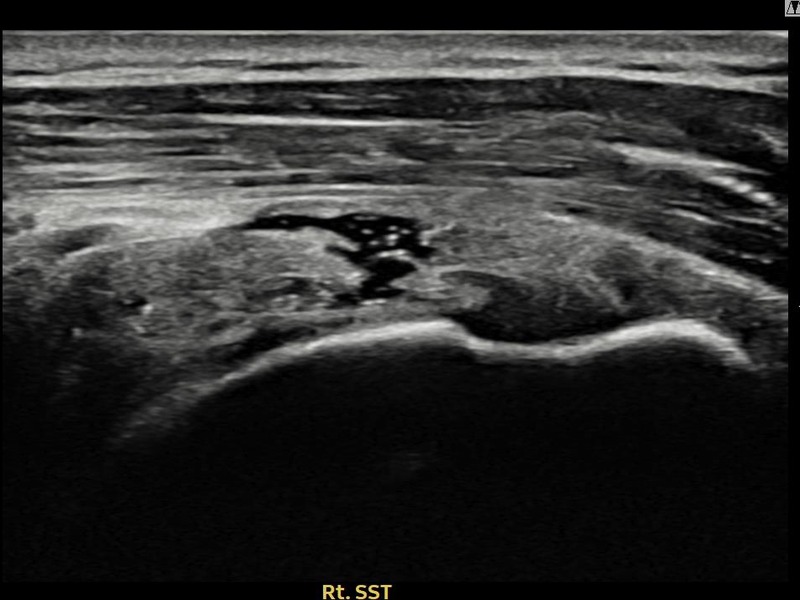 우측 극상근건 부분파열 + 건내 석회화 비수술 치료 전 초음파 — 플래티넘의원