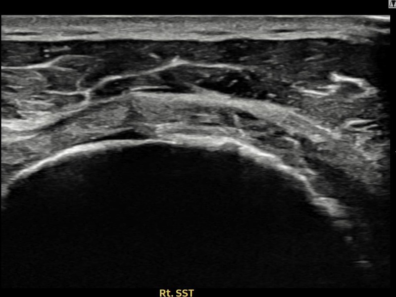 우측 극상근건 관절면측 광범위 부분파열 비수술 치료 후 초음파 — 플래티넘의원
