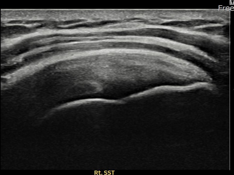 우측 견갑하근건 부분파열 비수술 치료 후 초음파 — 플래티넘의원