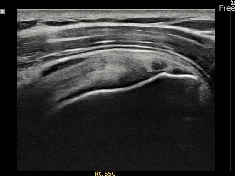 우측 견갑하근건 부분파열 비수술 치료 전 초음파 — 플래티넘의원