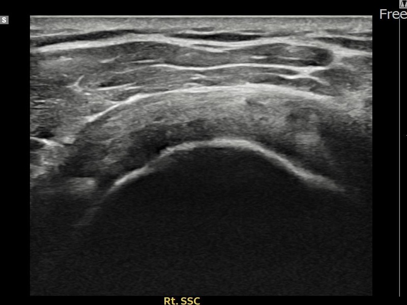 우측 견갑하근건 관절면측 부분파열 비수술 치료 전 초음파 — 플래티넘의원
