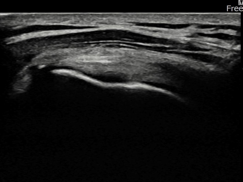 좌측 극상근건 부분파열 비수술 치료 후 초음파 — 플래티넘의원