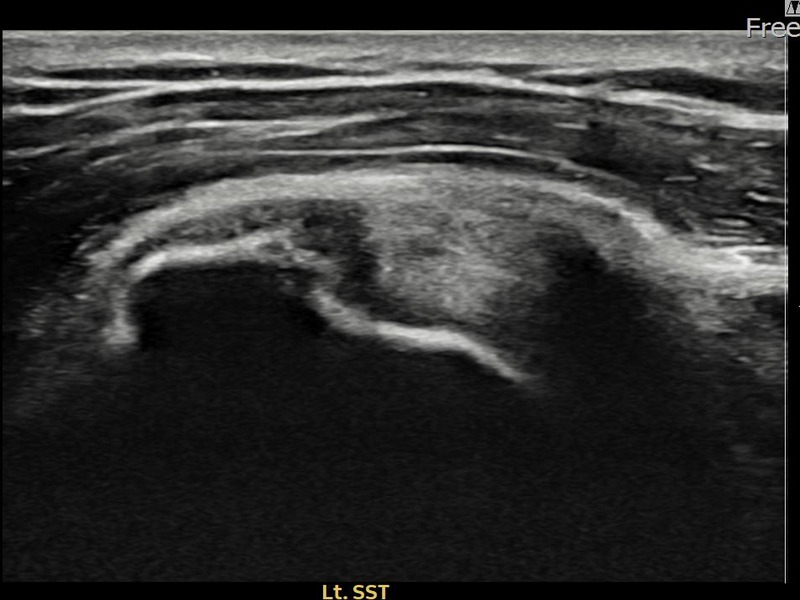 좌측 극상근건 부분파열 비수술 치료 전 초음파 — 플래티넘의원