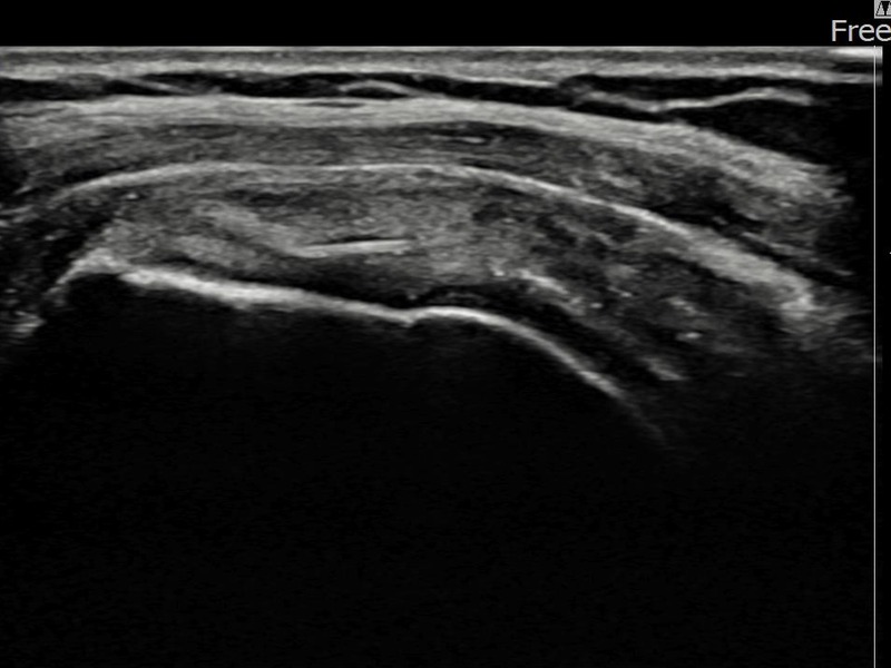 좌측 극상근건 부착부 부분파열 비수술 치료 후 초음파 — 플래티넘의원