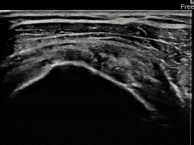 좌측 극상근건 관절면측 부분파열 비수술 치료 후 초음파 — 플래티넘의원