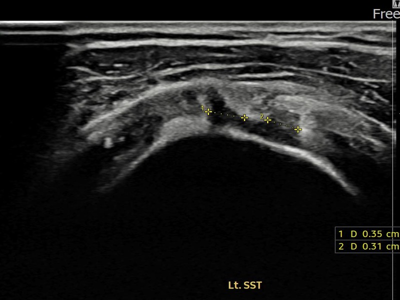 좌측 극상근건 관절면측 부분파열 비수술 치료 전 초음파 — 플래티넘의원