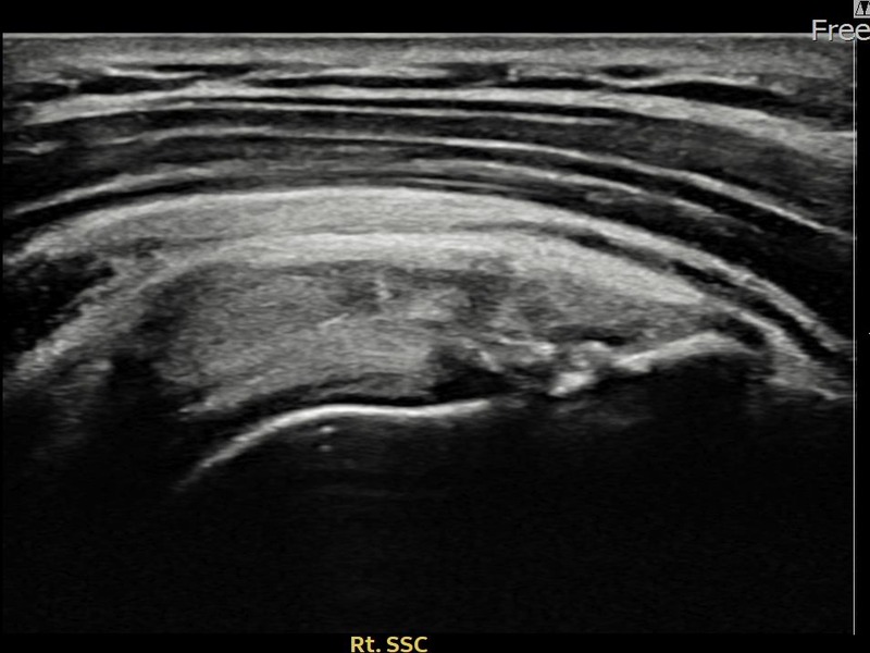 우측 극하근건 부착부 부분파열 비수술 치료 후 초음파 — 플래티넘의원