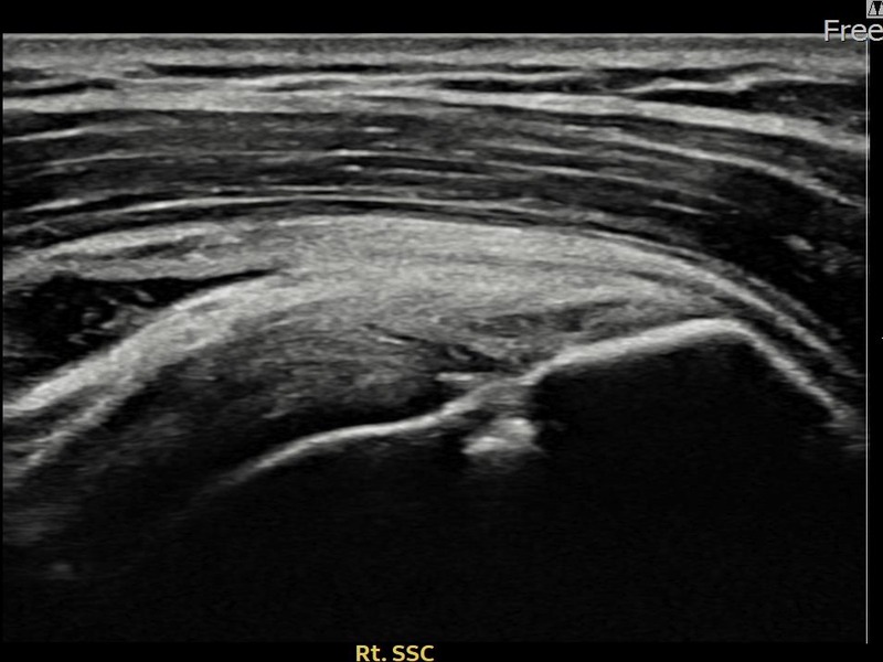 우측 극하근건 관절면측 부분파열 비수술 치료 후 초음파 — 플래티넘의원