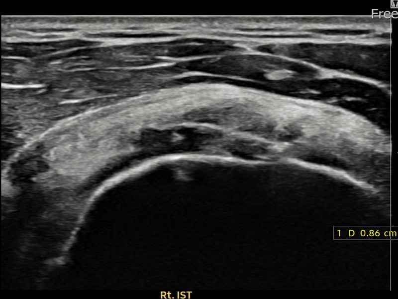 우측 극하근건 관절면측 부분파열 비수술 치료 전 초음파 — 플래티넘의원