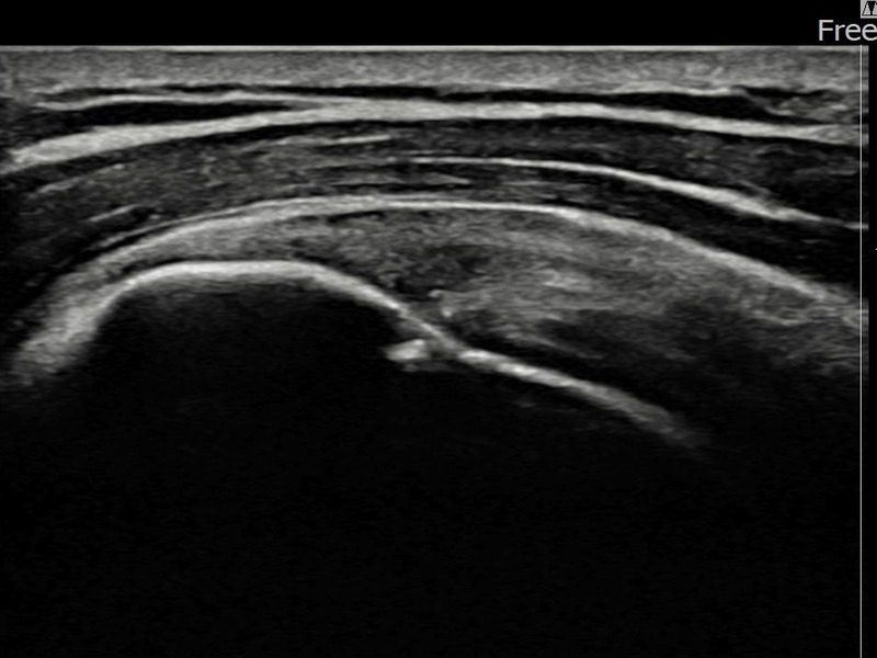 좌측 극상근건 부착부 부분파열 비수술 치료 후 초음파 — 플래티넘의원