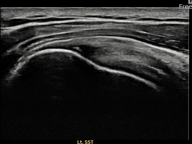 좌측 극상근건 부착부 부분파열 비수술 치료 전 초음파 — 플래티넘의원