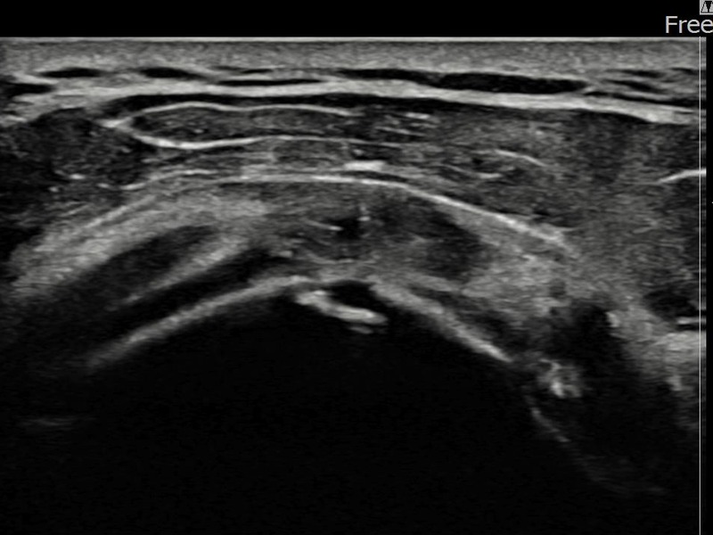 좌측 극상근건 관절면측 부분파열 비수술 치료 후 초음파 — 플래티넘의원